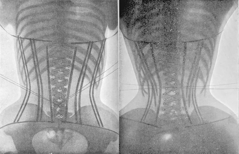 X-ray of the effect of corsets on women's bones